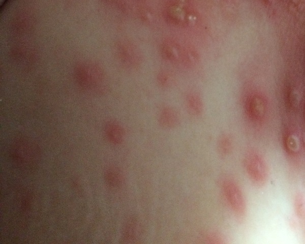 To ask what I can put on chicken pox on toddlers bits?