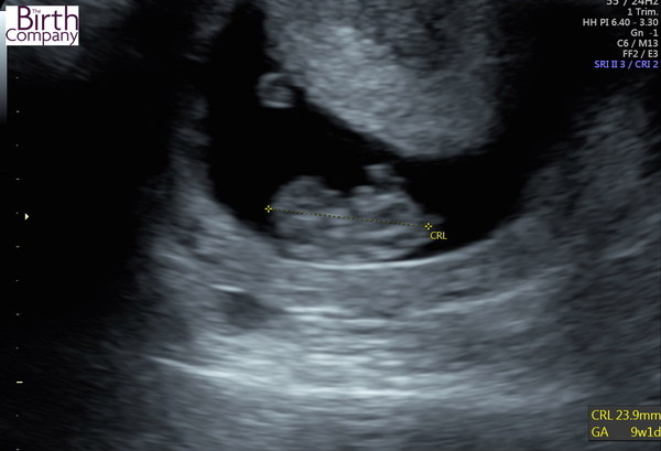 December 2017 babies #5 - dating scans and food chat, and dwindling symptoms???