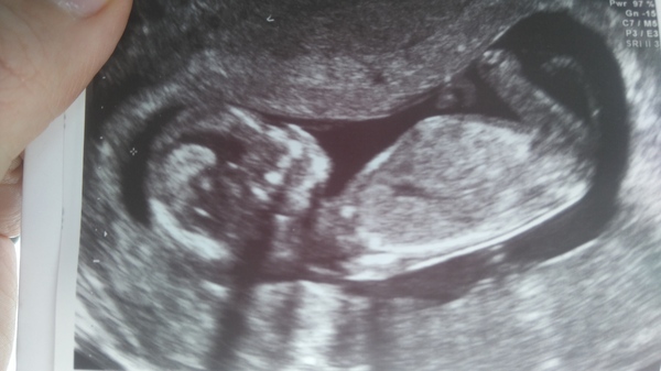 Nothing seen on the scan