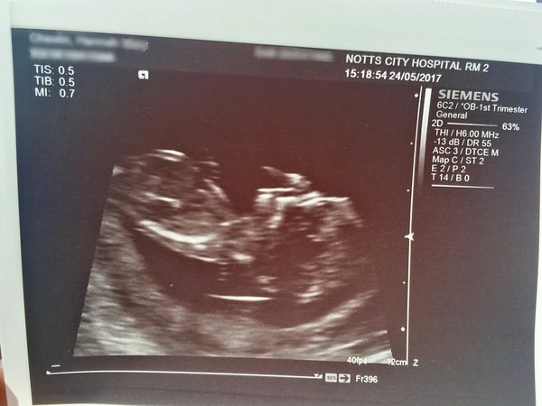 December 2017 babies #5 - dating scans and food chat, and dwindling symptoms???