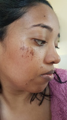 Horribly ripped skin during a Professional facial wax, please help! Pics attached.