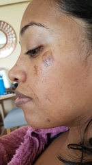 Horribly ripped skin during a Professional facial wax, please help! Pics attached.