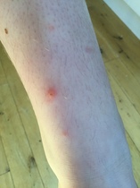 DD 11 has chicken pox again, I think