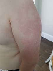 Is this slapped cheek?