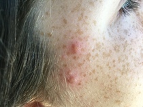 DD 11 has chicken pox again, I think