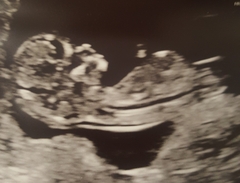 12 week vs 20 week scan