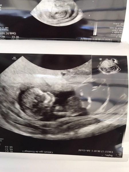 December 2017 babies #6 - dating scans, gender reveals, the beginning of bumps & the 2nd trimester!