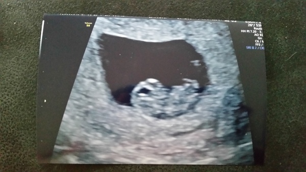 First Time Pregnancy (3)