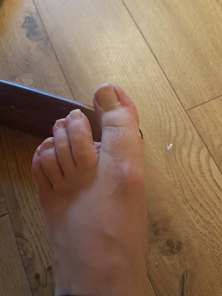 Please diagnose my toes