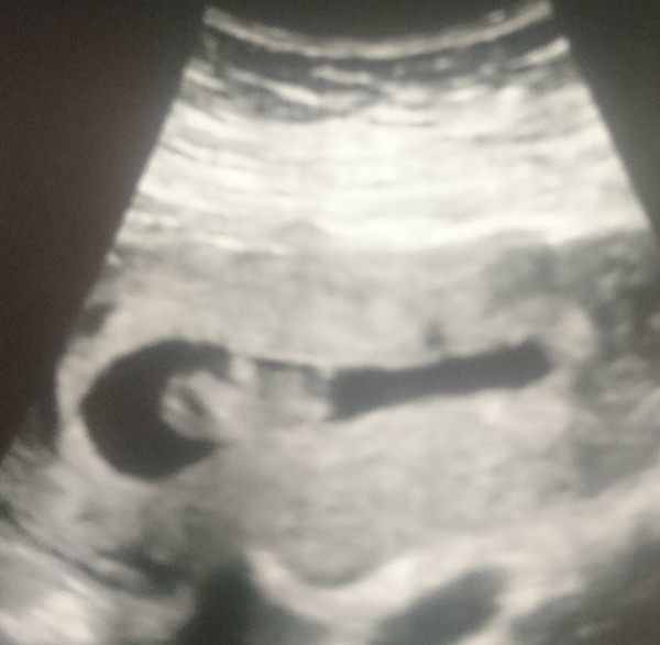 January 2018 babies - early scans and midwife appointments!