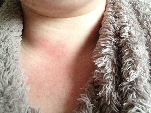 What is this rash?