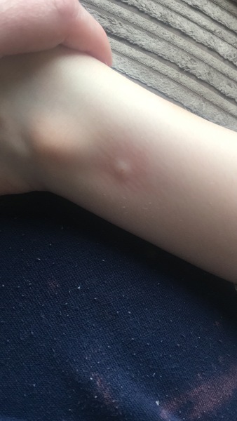 Chicken pox