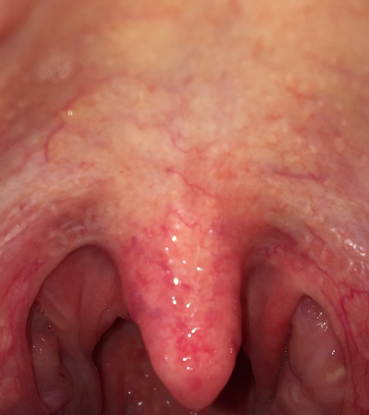 Tonsillitis progression?