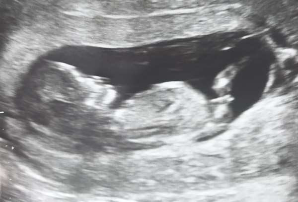 December 2017 babies #6 - dating scans, gender reveals, the beginning of bumps & the 2nd trimester!