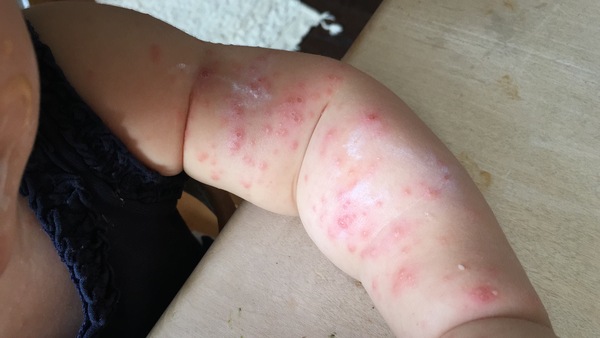 Is this chicken pox?