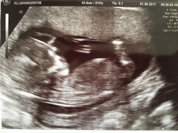 December 2017 babies #5 - dating scans and food chat, and dwindling symptoms???