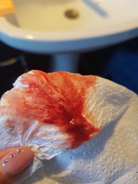 Bleeding after Mc! Pics attached! Please Help!