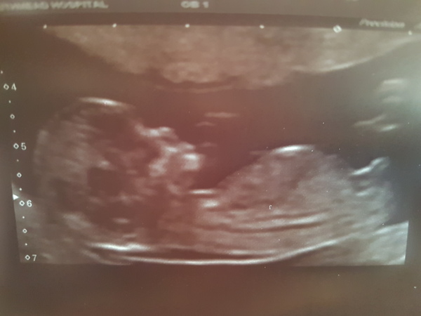 December 2017 babies #6 - dating scans, gender reveals, the beginning of bumps & the 2nd trimester!