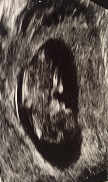 December 2017 babies #5 - dating scans and food chat, and dwindling symptoms???