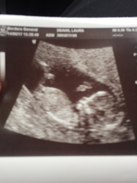 December 2017 babies #6 - dating scans, gender reveals, the beginning of bumps & the 2nd trimester!