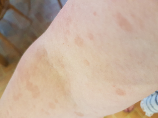 What are these, Rash, blisters? They are spreading, help!!