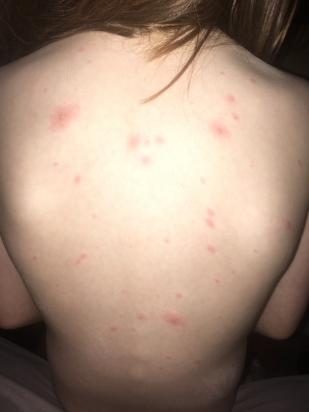 Chicken pox for a third time!