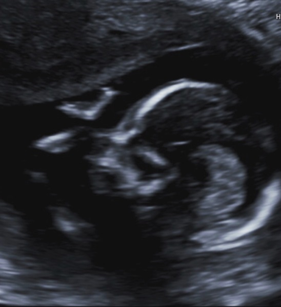 November 2017 #3: Flutters, bubbles and a proper bump!