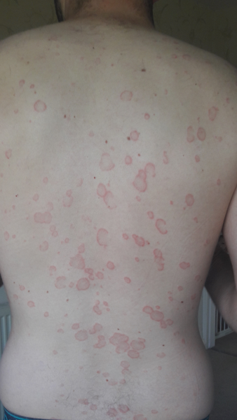 husband has odd rash on his back - pic included