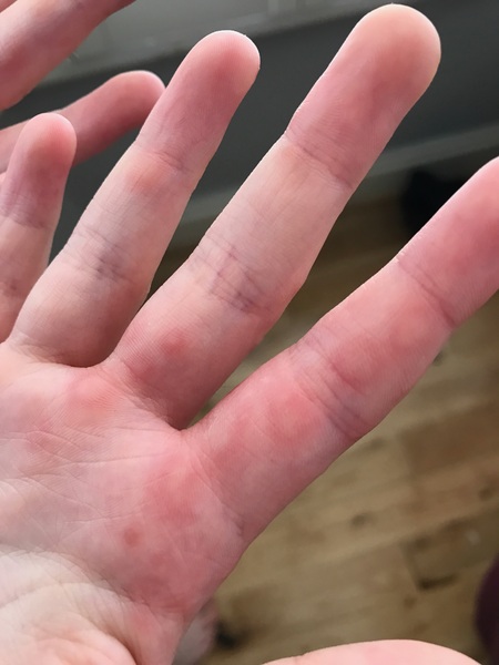 Secondary infection after Chicken Pox