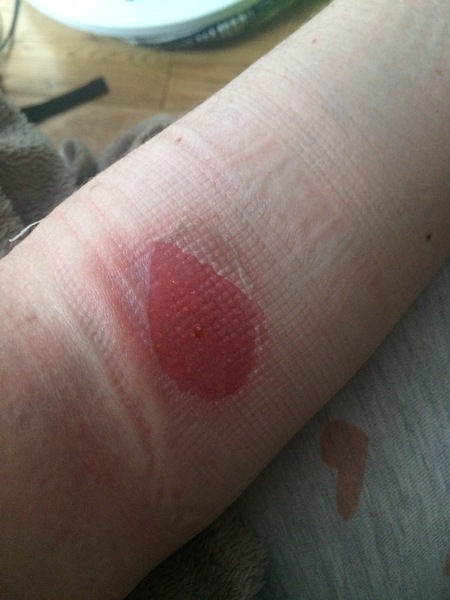 About burn to my arm