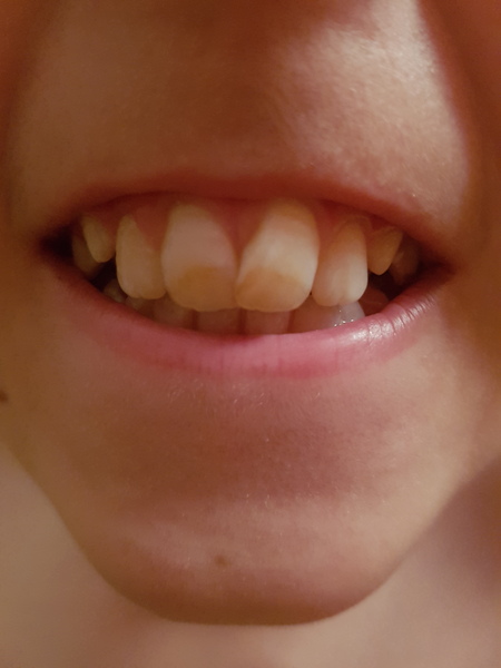 Any dentists can give advice on some teeth please?