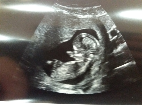 20 week scan tomorrow, any final guesses?