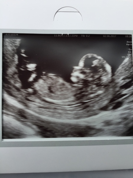 December 2017 babies #5 - dating scans and food chat, and dwindling symptoms???