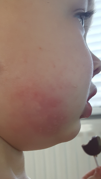 Ear infection and rash...