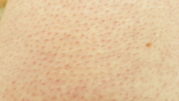 Spotty arms (pic inc)