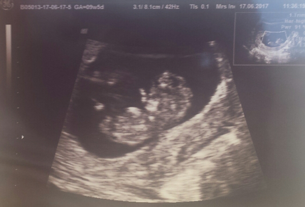 First baby due Jan 2018!