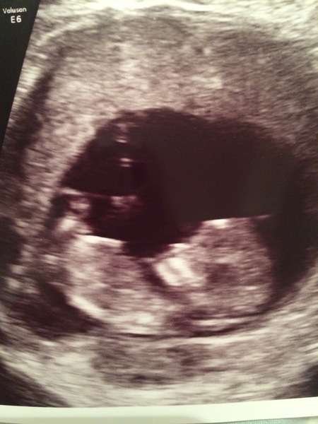 December 2017 babies #5 - dating scans and food chat, and dwindling symptoms???