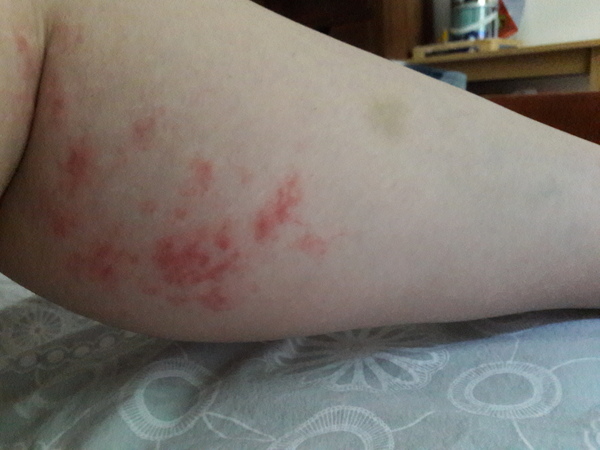 What's this rash (picture included)?