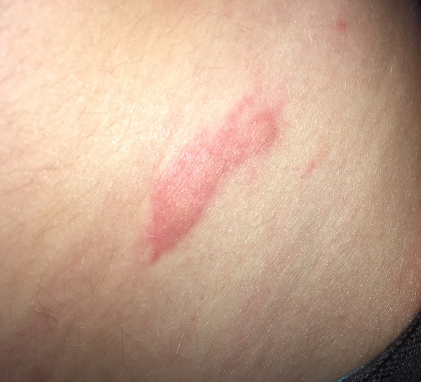 Is this a bug bite of some kind?