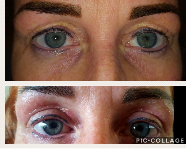 Plexr eye treatment