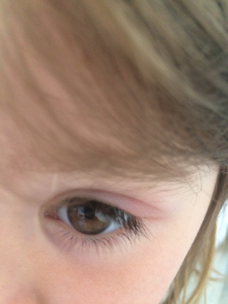 Swollwn eyelid