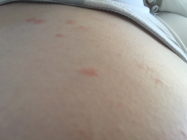 What are these, Rash, blisters? They are spreading, help!!