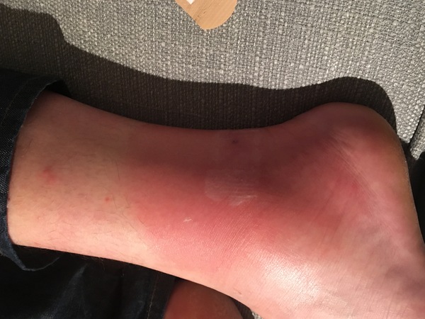 Opinions on DH's bite please?