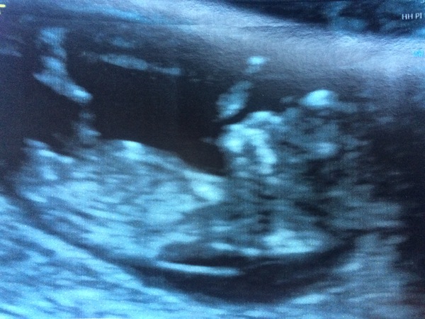 December 2017 babies #6 - dating scans, gender reveals, the beginning of bumps & the 2nd trimester!