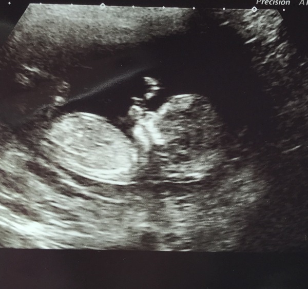 December 2017 babies #6 - dating scans, gender reveals, the beginning of bumps & the 2nd trimester!