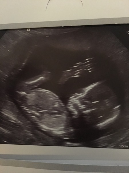 December 2017 babies #6 - dating scans, gender reveals, the beginning of bumps & the 2nd trimester!