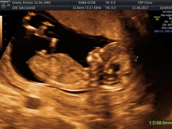 Immune/Natural Killer Cell treatment for those ttc or pregnant. (AKA the 19th pred thread!)