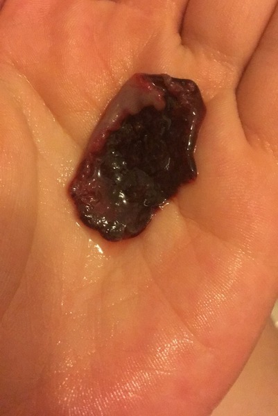 *******TMI - picture included, please don't look if you are squeemish******