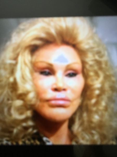 To think no-one looks good with cheek fillers?