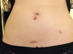 Scar healing after fallopian cyst